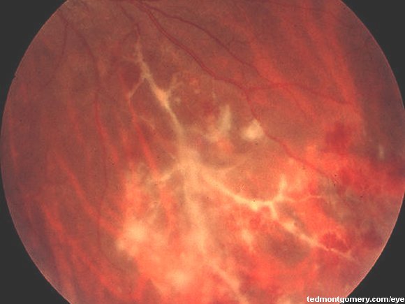 Sarcoidosis: #2