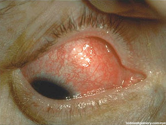 Scleritis