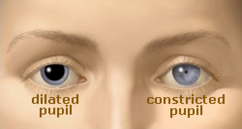 one pupil dilated suddenly