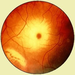Cherry red macula from Tay-Sachs