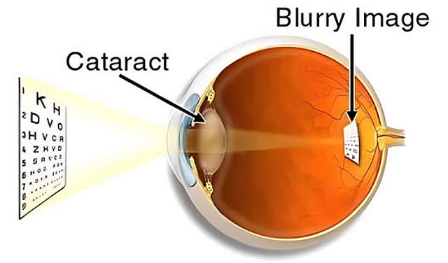 Cataract in the crystalline lens