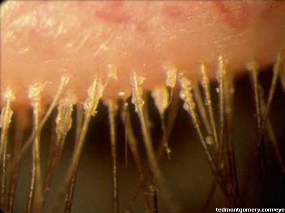Blepharitis