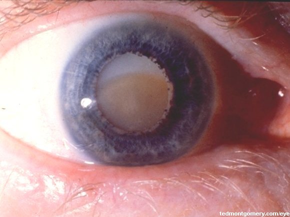 Morgagnian Cataract