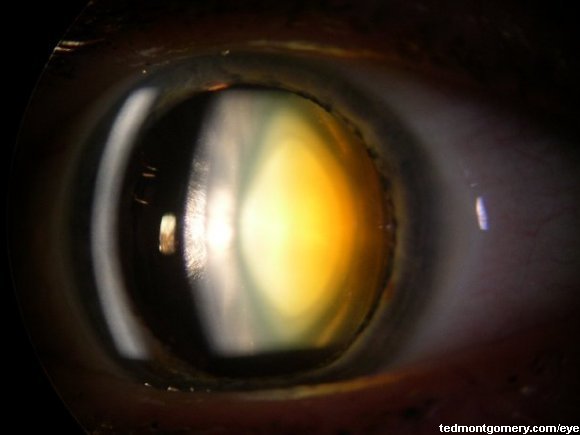 Nuclear Sclerotic Cataract: #2