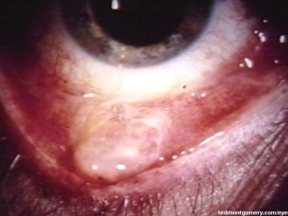 Conjunctival Granuloma