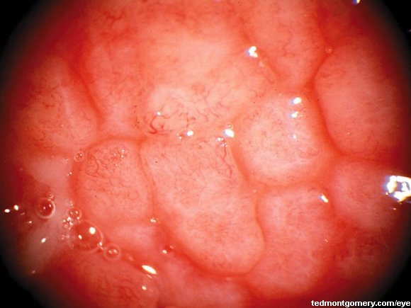 Giant Papillary Conjunctivitis: #2