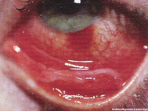 Epidemic Keratoconjunctivitis