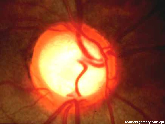 Glaucomatous Cupping: #4