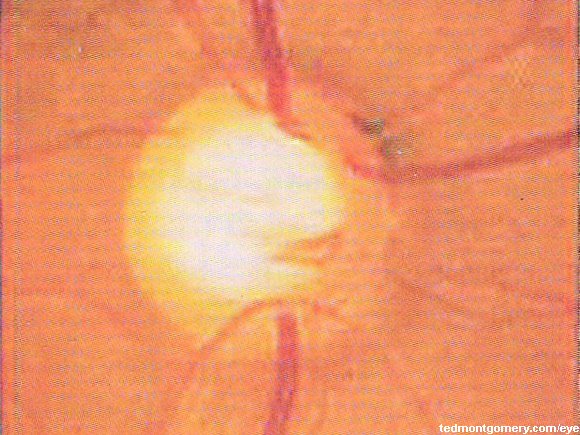 Glaucomatous Cupping: #5