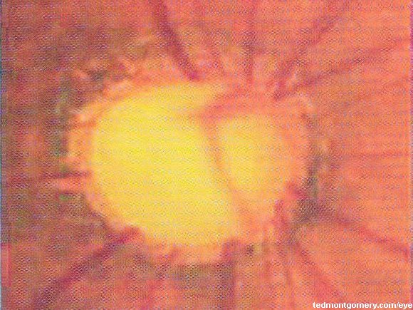 Glaucomatous Cupping: #6