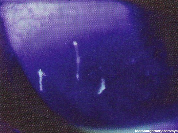 Filamentary Keratitis