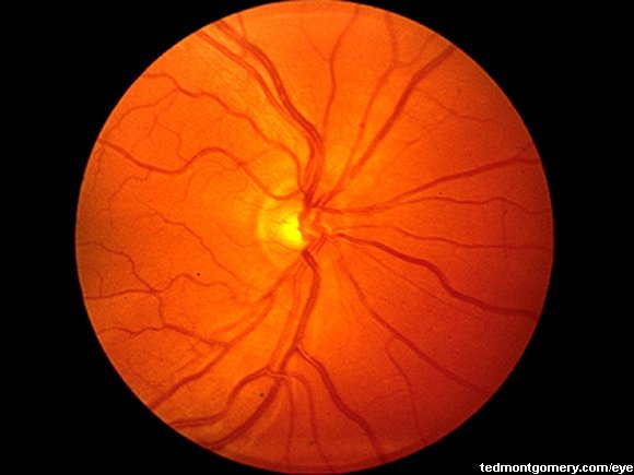 Normal Fundus: #2