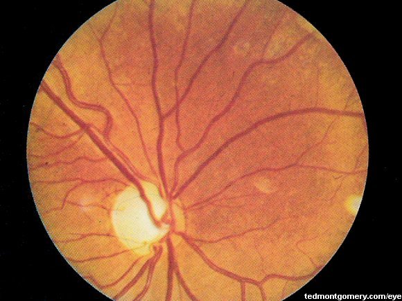 Primary Optic Atrophy