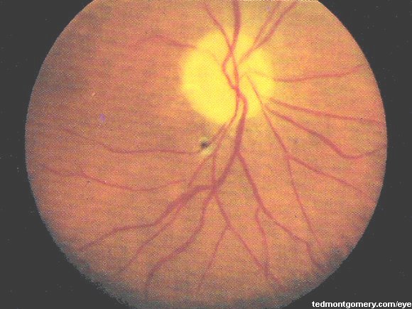 Secondary Optic Atrophy