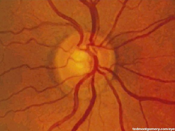 Normal Optic Disk 2