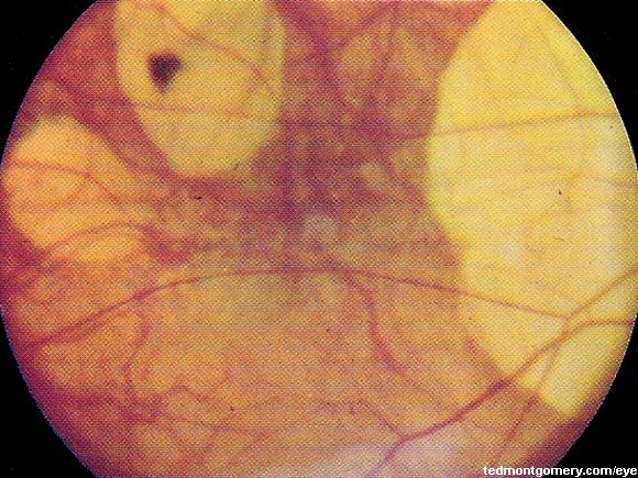 Posterior Staphyloma