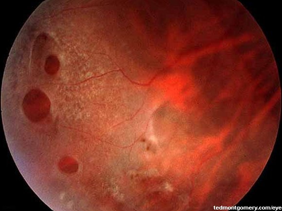 Retinal Holes