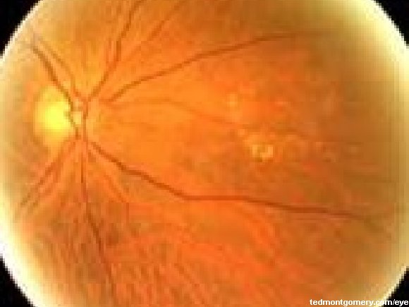 Retinal Telangiectasia