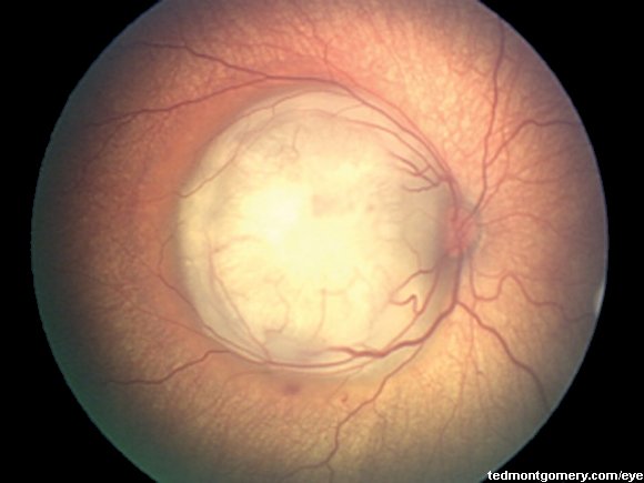 Retinoblastoma
